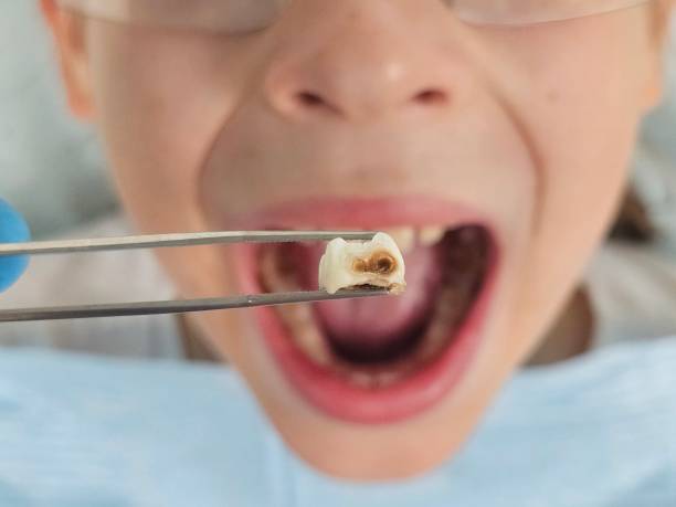 Best Emergency Tooth Extraction in Colonial Heights, VA